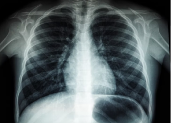 Lo strano ed incredibile caso delle polmoniti senza COVID (ma dicono che “sono COVID”): che magari tali polmoniti “- solo con effetti simili al COVID” – prima si chiamavano influenza?