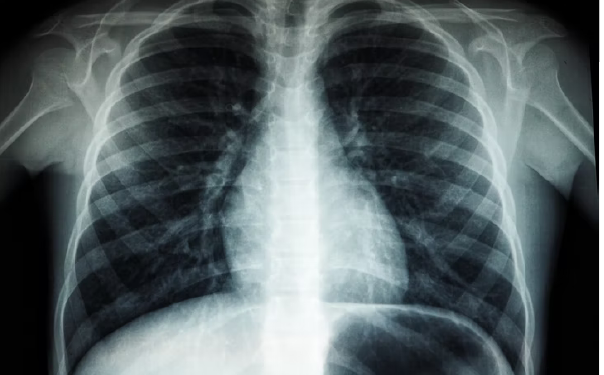 Lo strano ed incredibile caso delle polmoniti senza COVID (ma dicono che “sono COVID”): che magari tali polmoniti “- solo con effetti simili al COVID” – prima si chiamavano influenza?