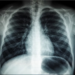 Lo strano ed incredibile caso delle polmoniti senza COVID (ma dicono che “sono COVID”): che magari tali polmoniti “- solo con effetti simili al COVID” – prima si chiamavano influenza?