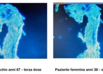 Importanti medici italiani dimostrano gli effetti potenzialmente devastanti del grafene nel corpo (post vaccino COVID?): i vetrini sanguigni spiegati