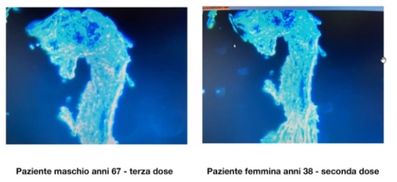 Importanti medici italiani dimostrano gli effetti potenzialmente devastanti del grafene nel corpo (post vaccino COVID?): i vetrini sanguigni spiegati